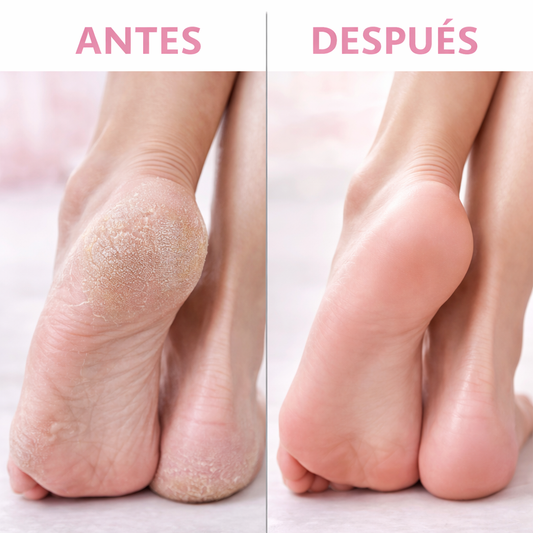 PediSoft Pro – Removedor Eléctrico de Callos